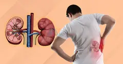 Common Risk factors or symptoms for Kidney Stones? - 1