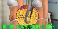 Tummy Tuck Surgery in India | EdhaCare - 1