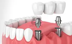 Dental Implants in Whitefield-Dental Implants Surgery - 2