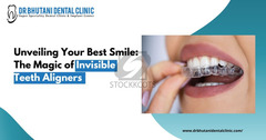 Unveiling Your Best Smile: The Magic of Invisible Teeth Aligners - 1